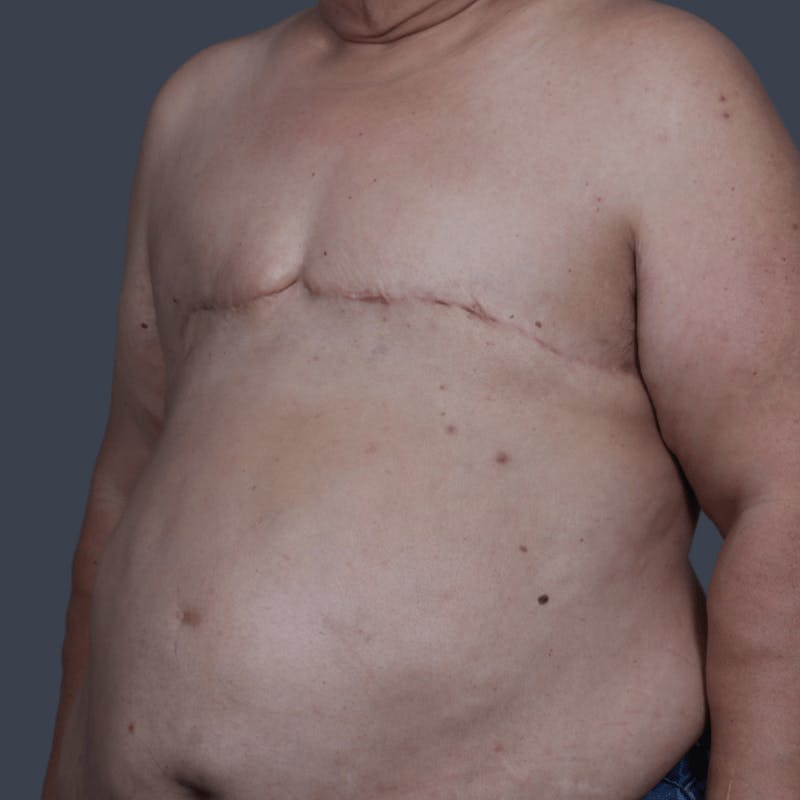 Top Surgery Before & After Gallery - Patient 150310 - Image 4