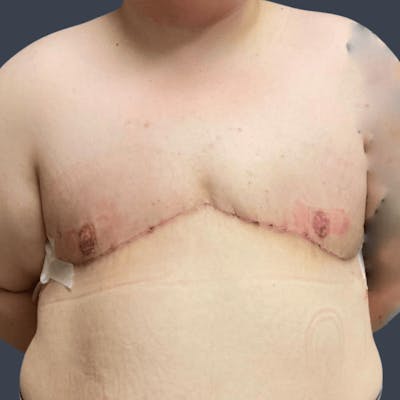 Top Surgery Before & After Gallery - Patient 248699 - Image 2