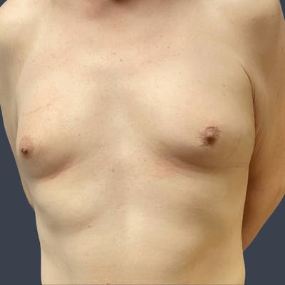 Top Surgery Before & After Gallery - Patient 242549 - Image 1