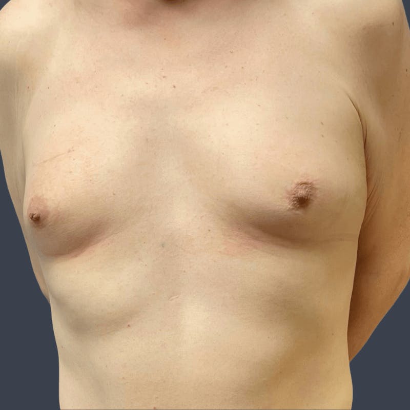 Top Surgery Before & After Gallery - Patient 242549 - Image 1