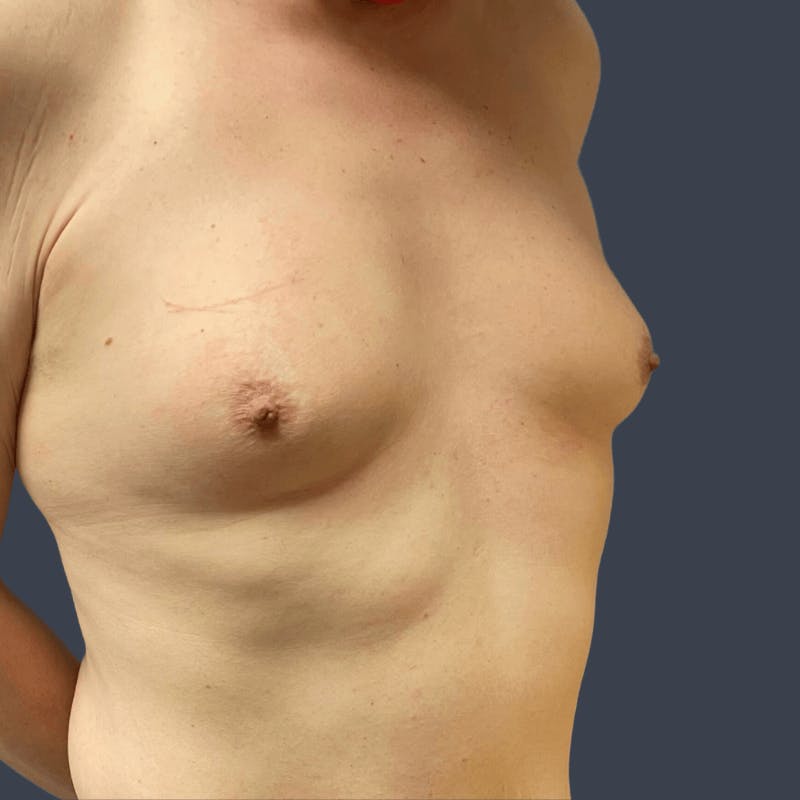 Top Surgery Before & After Gallery - Patient 242549 - Image 3