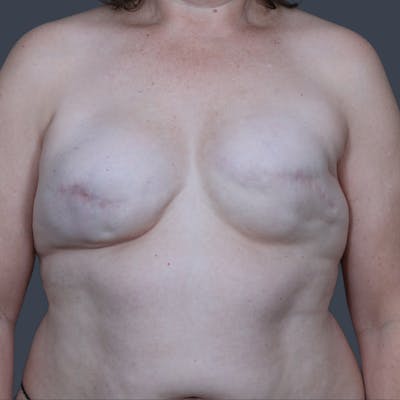 Breast Reconstruction Revision Before & After Gallery - Patient 236153 - Image 1