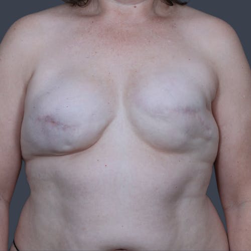 Before procedure image for Breast Reconstruction Revision