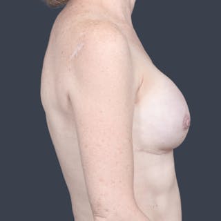 Breast Reconstruction Revision Before & After Gallery - Patient 232306 - Image 4