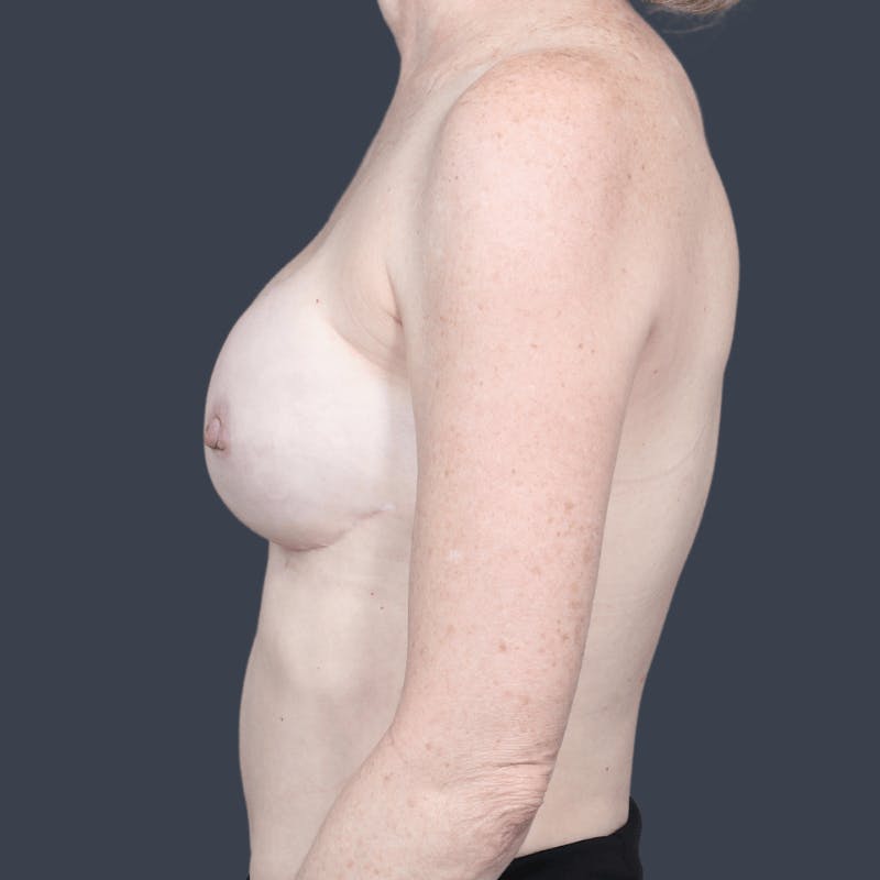 Breast Reconstruction Revision Before & After Gallery - Patient 232306 - Image 10