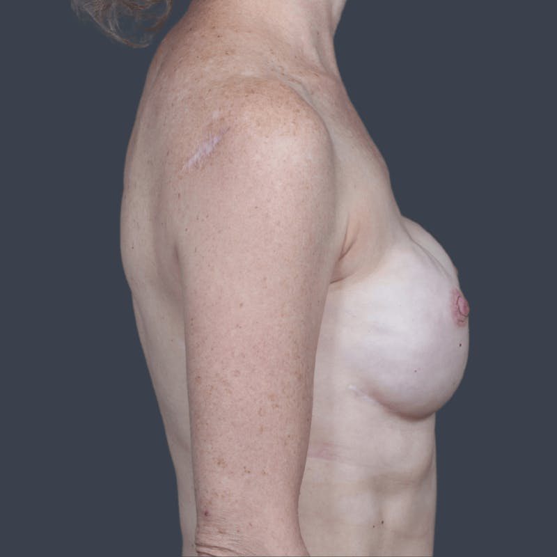 Breast Reconstruction Revision Before & After Gallery - Patient 232306 - Image 3