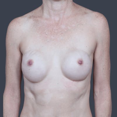 Breast Reconstruction Revision Before & After Gallery - Patient 232306 - Image 1