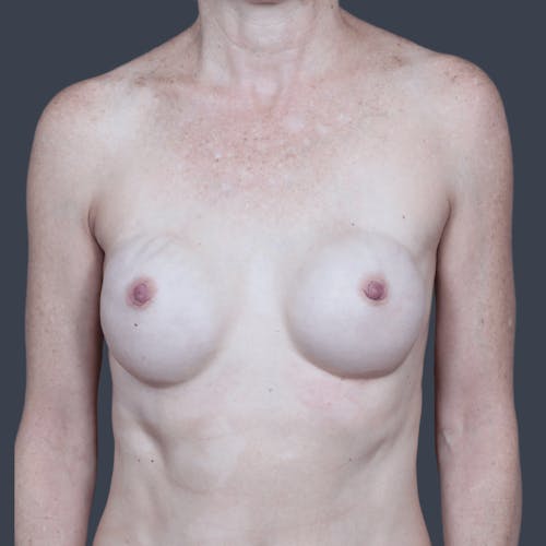 Before procedure image for Breast Reconstruction Revision