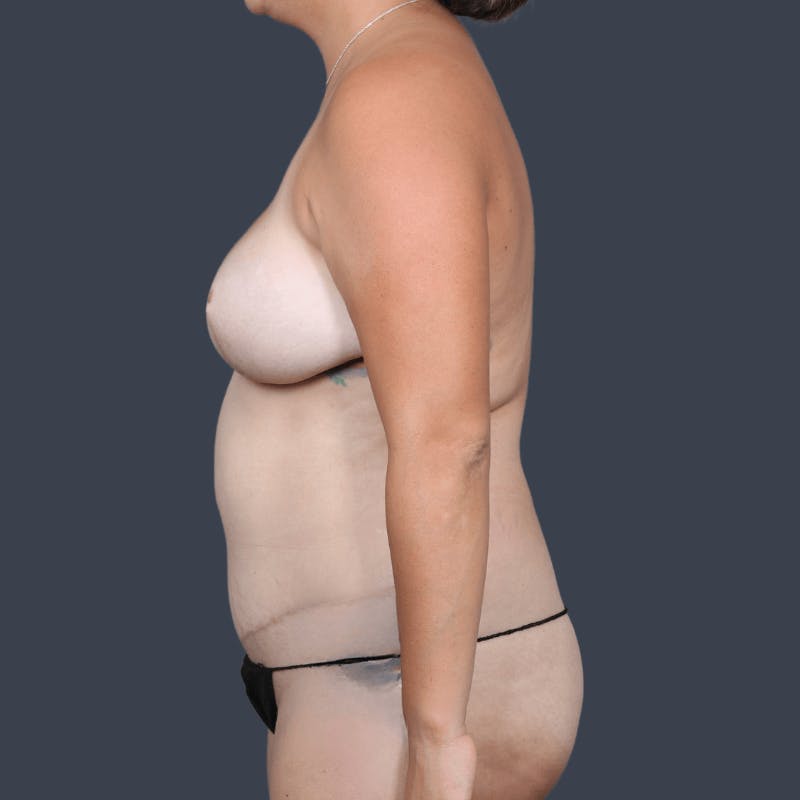 Areola Tattooing Before & After Gallery - Patient 326675 - Image 9