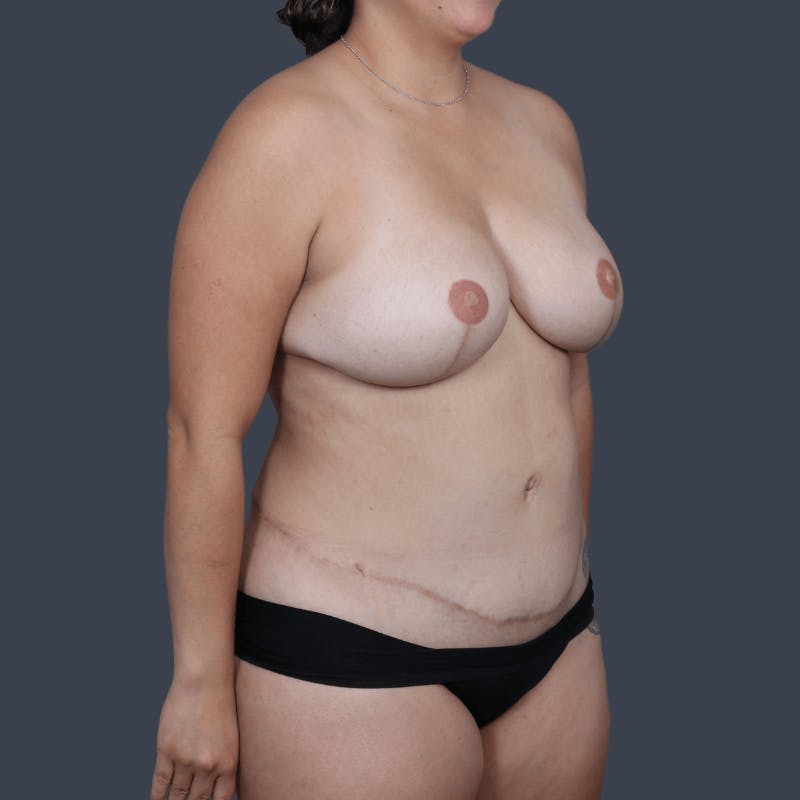 Areola Tattooing Before & After Gallery - Patient 326675 - Image 6
