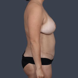 Breast Reconstruction Revision Before & After Gallery - Patient 244610 - Image 4