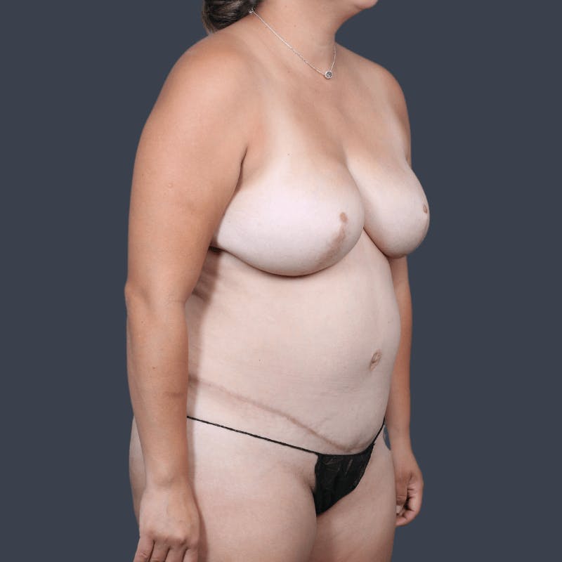 Areola Tattooing Before & After Gallery - Patient 326675 - Image 5
