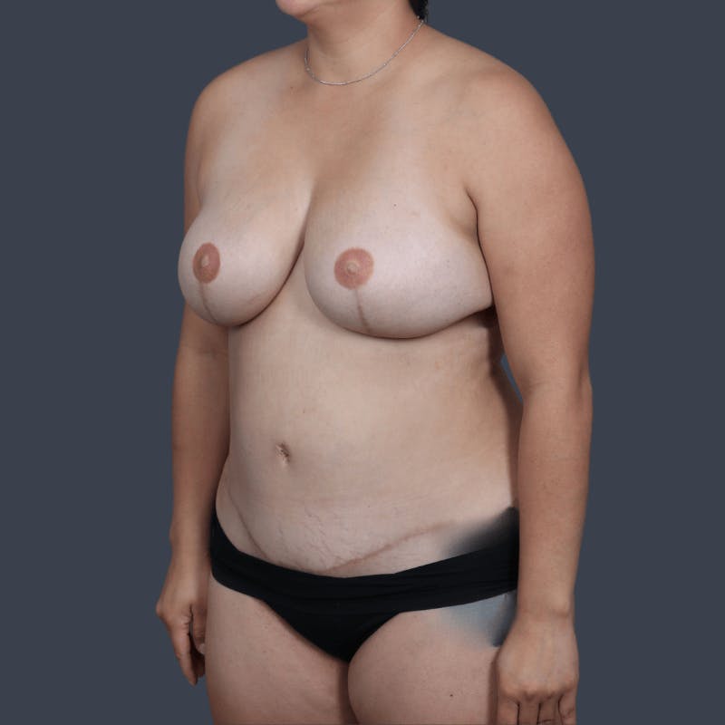 Areola Tattooing Before & After Gallery - Patient 326675 - Image 8