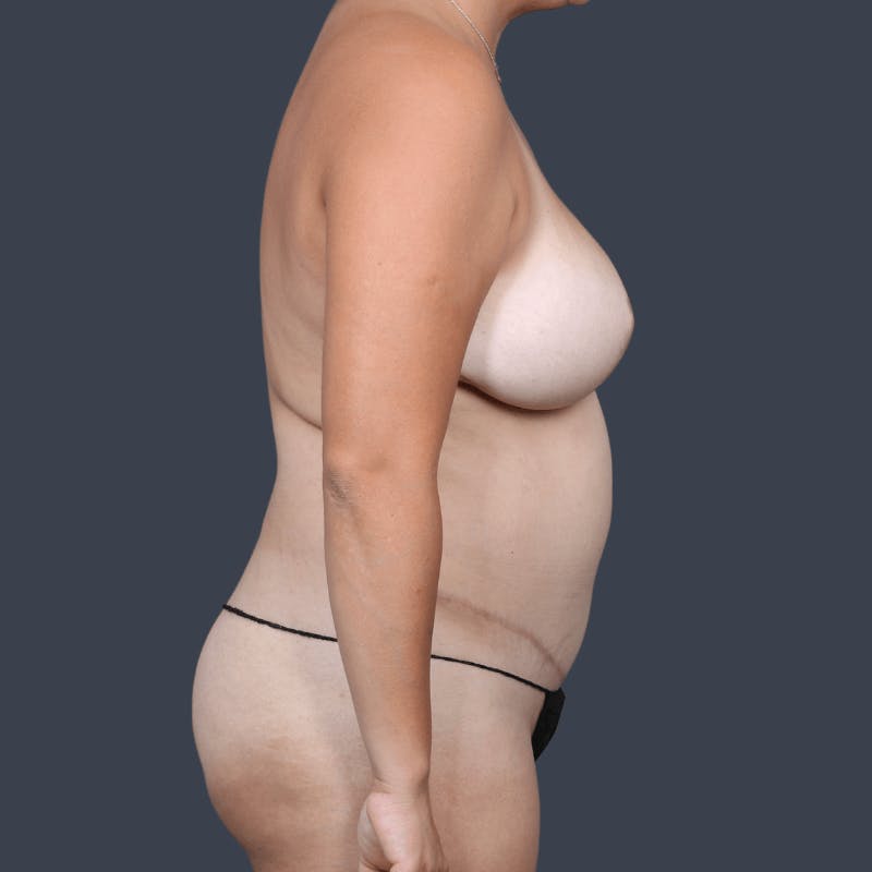 Areola Tattooing Before & After Gallery - Patient 326675 - Image 3
