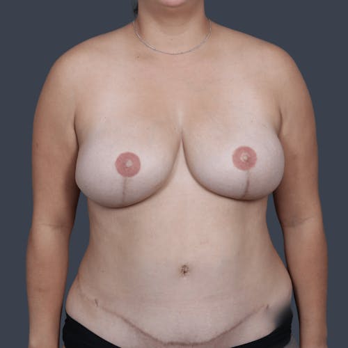 After procedure image for Breast Reconstruction Revision