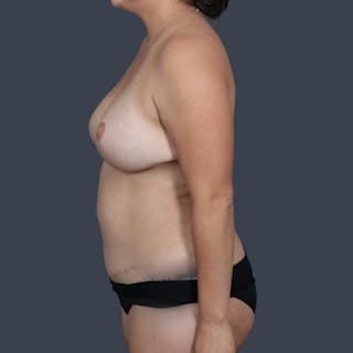 Breast Reconstruction Revision Before & After Gallery - Patient 244610 - Image 10