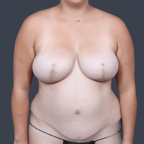 Before procedure image for Breast Reconstruction Revision
