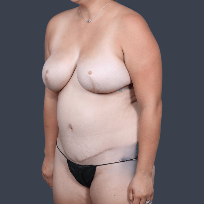 Areola Tattooing Before & After Gallery - Patient 326675 - Image 7
