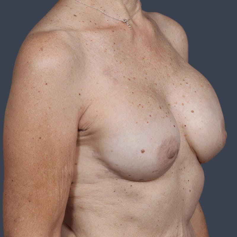 Implant Breast Reconstruction Before & After Gallery - Patient 237010 - Image 6