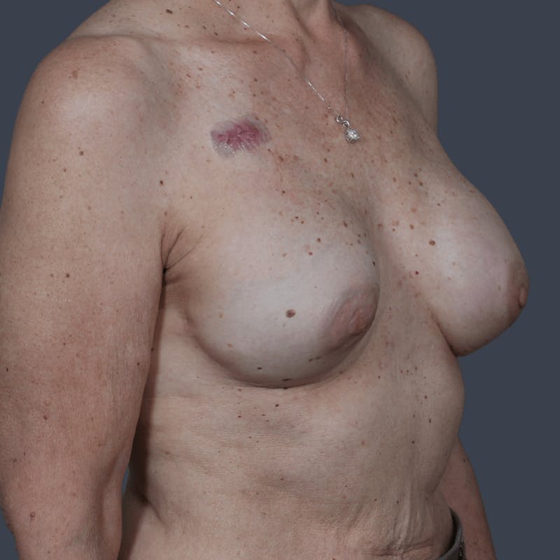 Implant Breast Reconstruction Before & After Gallery - Patient 237010 - Image 5