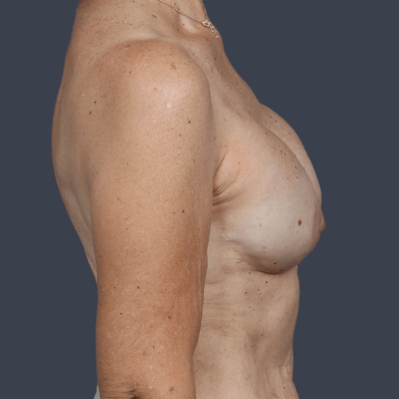 Implant Breast Reconstruction Before & After Gallery - Patient 237010 - Image 4