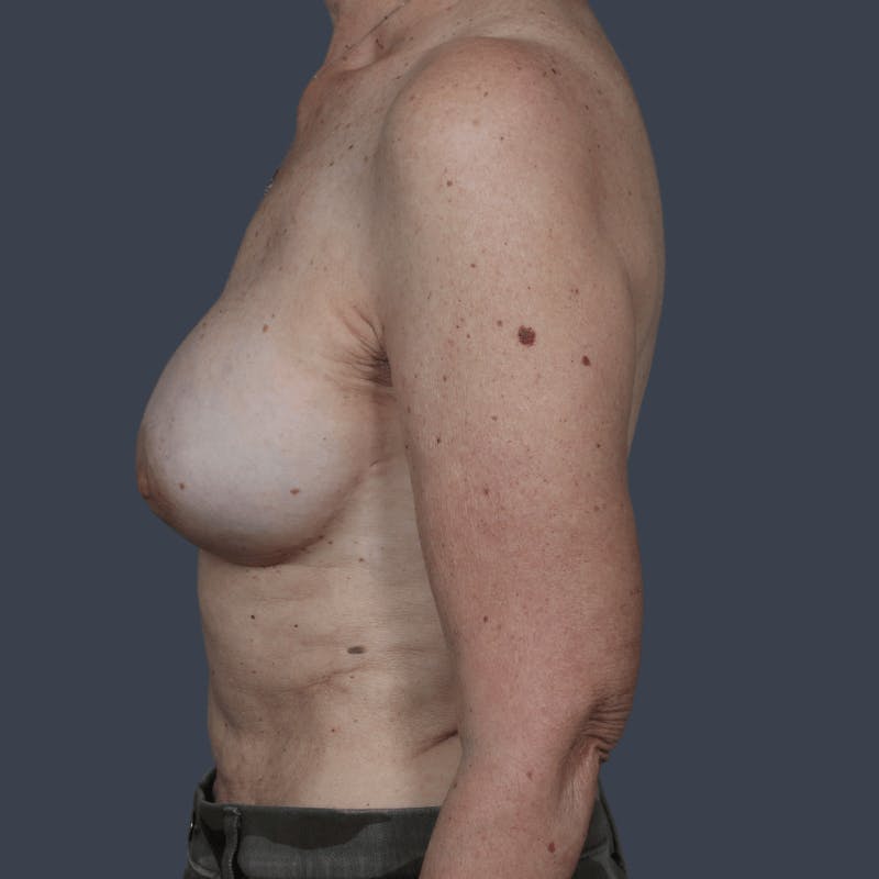 Implant Breast Reconstruction Before & After Gallery - Patient 237010 - Image 9