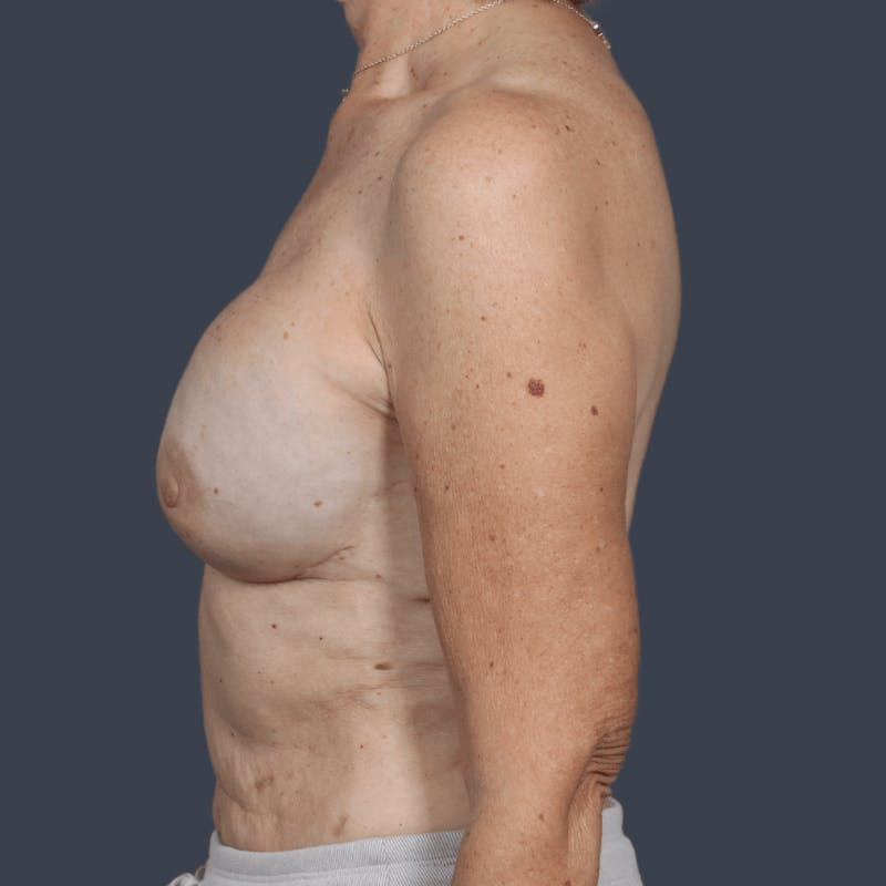 Implant Breast Reconstruction Before & After Gallery - Patient 237010 - Image 10