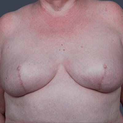 Breast Reconstruction Revision Before & After Gallery - Patient 109538 - Image 2