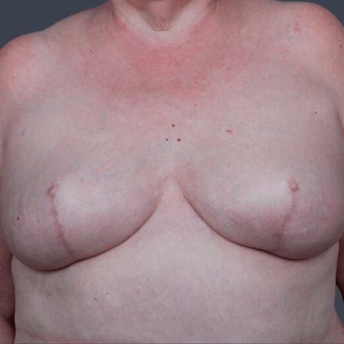 After procedure image for Breast Reconstruction Revision