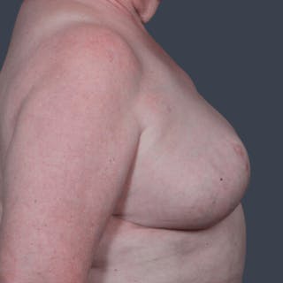 Breast Reconstruction Revision Before & After Gallery - Patient 109538 - Image 4