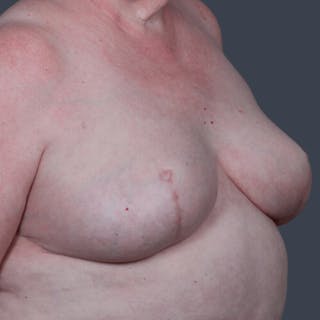 Breast Reconstruction Revision Before & After Gallery - Patient 109538 - Image 6