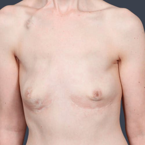 Before procedure image for Breast Reconstruction Revision