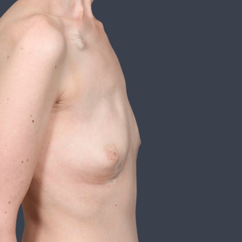 Breast Reconstruction Revision Before & After Gallery - Patient 323119 - Image 5
