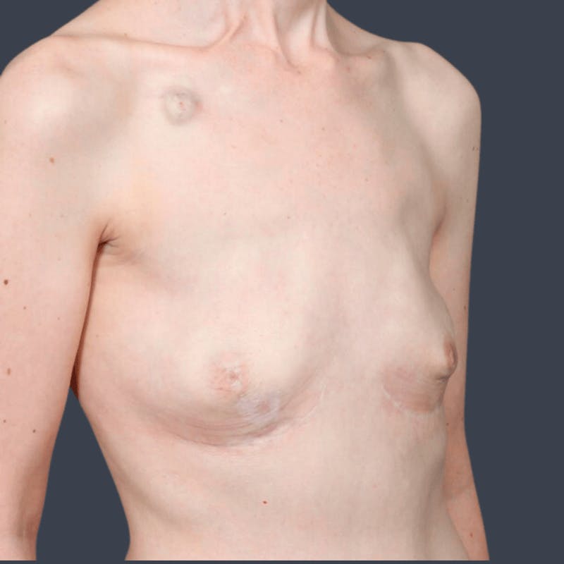 Breast Reconstruction Revision Before & After Gallery - Patient 323119 - Image 3