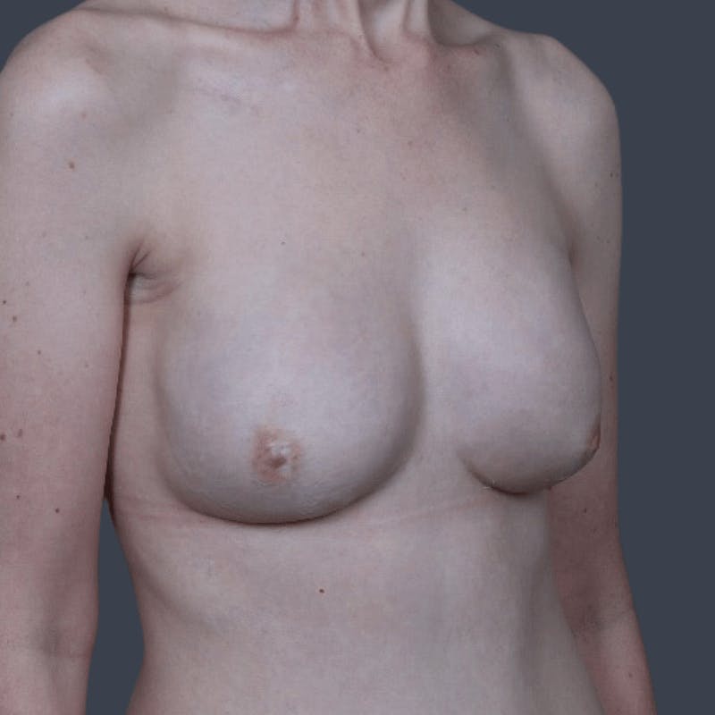Breast Reconstruction Revision Before & After Gallery - Patient 323119 - Image 4