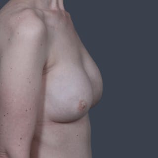 Breast Reconstruction Revision Before & After Gallery - Patient 323119 - Image 6
