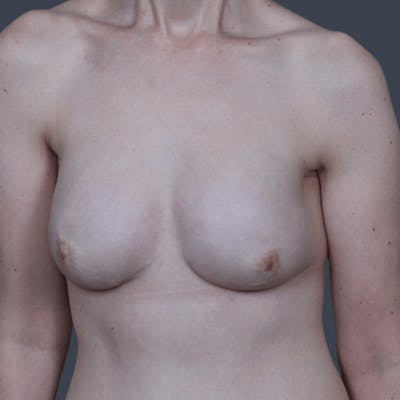 Breast Reconstruction Revision Before & After Gallery - Patient 323119 - Image 2