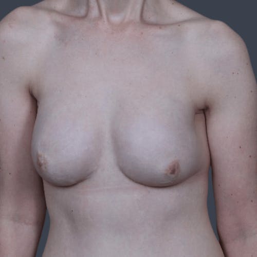 After procedure image for Breast Reconstruction Revision