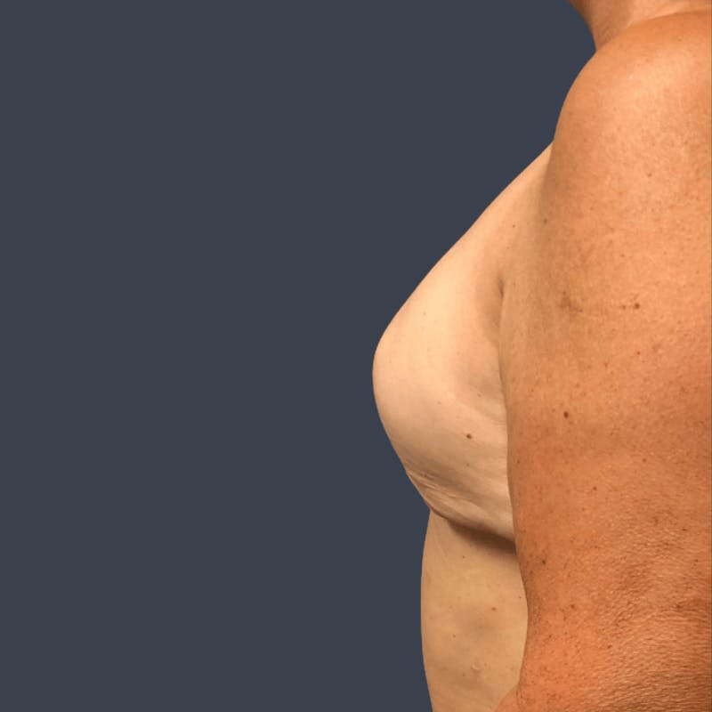 Breast Reconstruction Revision Before & After Gallery - Patient 196490 - Image 3