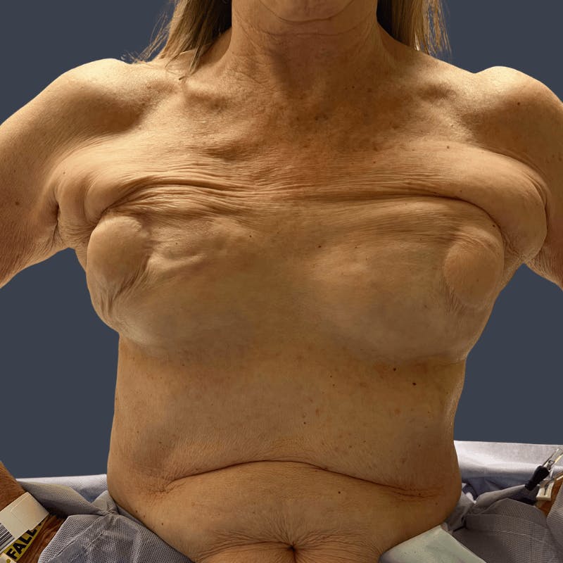 Breast Reconstruction Revision Before & After Gallery - Patient 375049 - Image 5