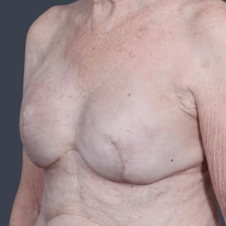 Breast Reconstruction Revision Before & After Gallery - Patient 375049 - Image 4