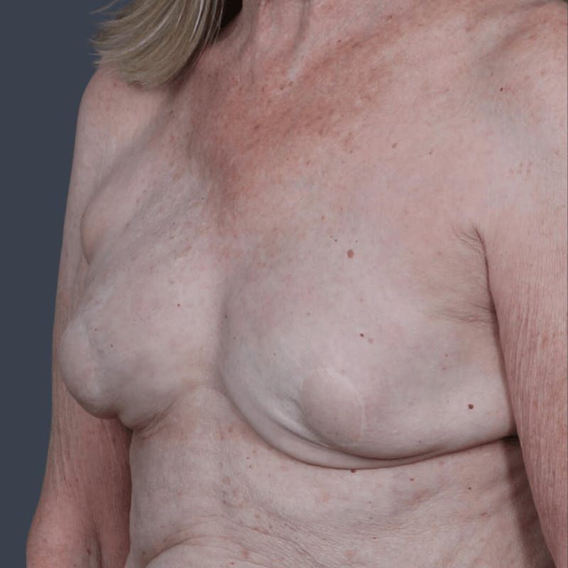 Breast Reconstruction Revision Before & After Gallery - Patient 375049 - Image 3