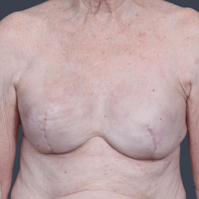 Breast Reconstruction Revision Before & After Gallery - Patient 375049 - Image 2