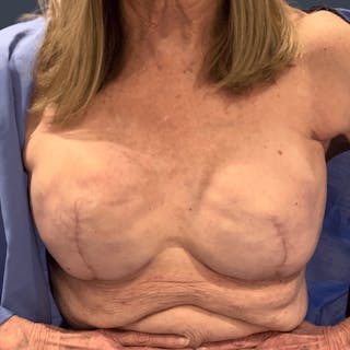 Breast Reconstruction Revision Before & After Gallery - Patient 375049 - Image 6