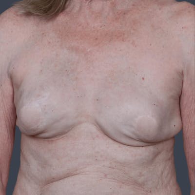 Hybrid Breast Reconstruction Before & After Gallery - Patient 153656 - Image 1