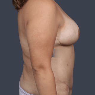 Breast Reconstruction Revision Before & After Gallery - Patient 124747 - Image 4