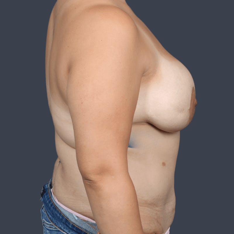 Breast Reconstruction Revision Before & After Gallery - Patient 124747 - Image 5
