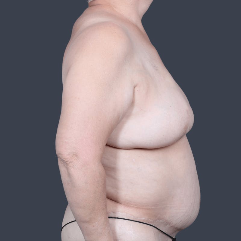 Breast Reconstruction Revision Before & After Gallery - Patient 343087 - Image 3