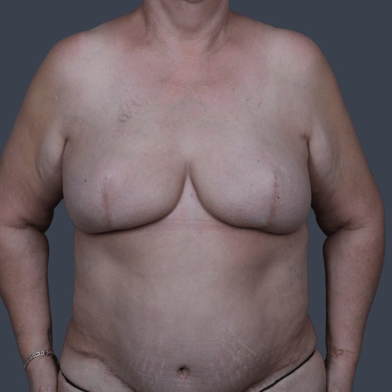 Breast Reconstruction Revision Before & After Gallery - Patient 343087 - Image 2