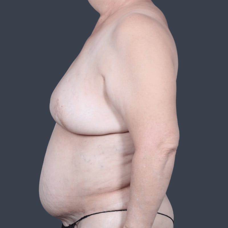 Breast Reconstruction Revision Before & After Gallery - Patient 343087 - Image 9